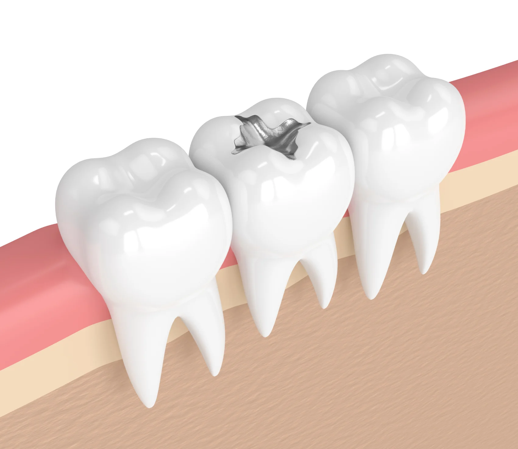 This is a thumbnail image of blog 18. The Truth About Silver Fillings: What You Need to Know Before You Decide This is a thumbnail image of blog 18. The Truth About Silver Fillings: What You Need to Know Before You Decide