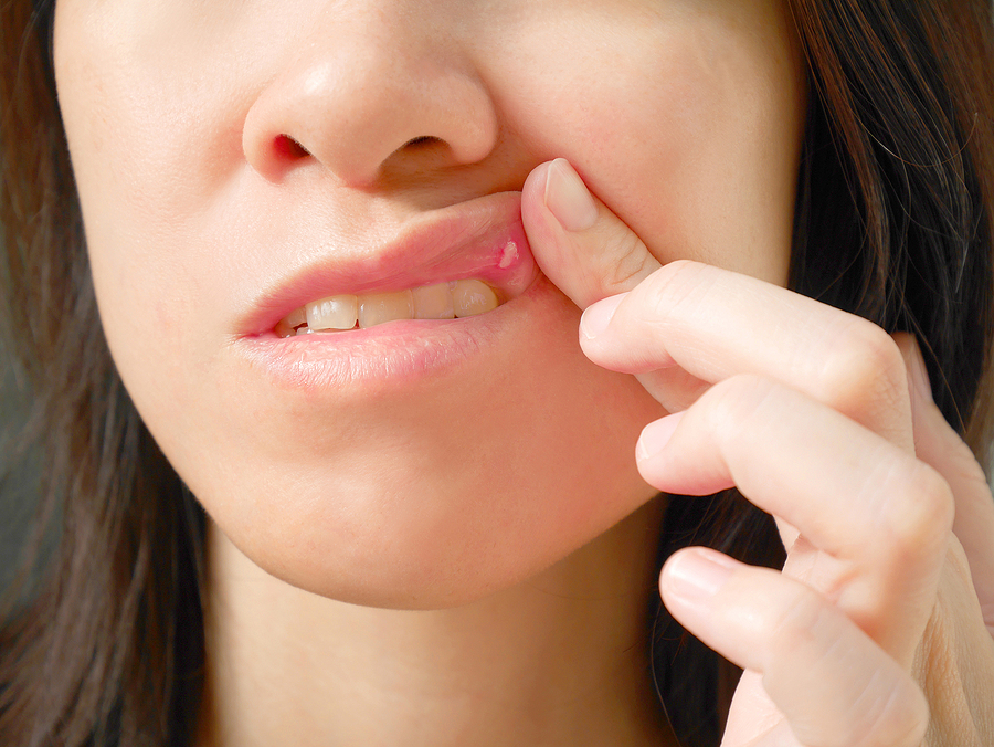 This is a thumbnail image of blog 8. Canker Sores: Swords That Don’t Kill—but Sure Do Hurt This is a thumbnail image of blog 8. Canker Sores: Swords That Don’t Kill—but Sure Do Hurt