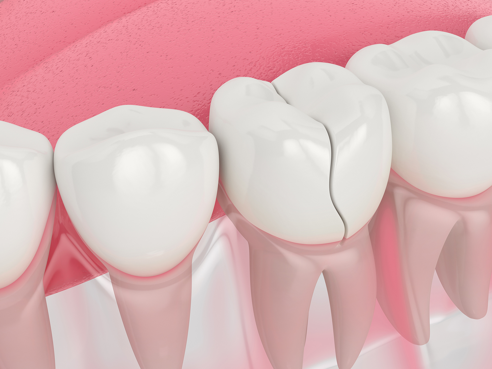 This is a thumbnail image of blog 9. When a Cracked Tooth Means Trouble (and What You Can Do About It) This is a thumbnail image of blog 9. When a Cracked Tooth Means Trouble (and What You Can Do About It)