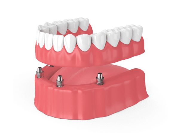 Durable implant-supported dentures