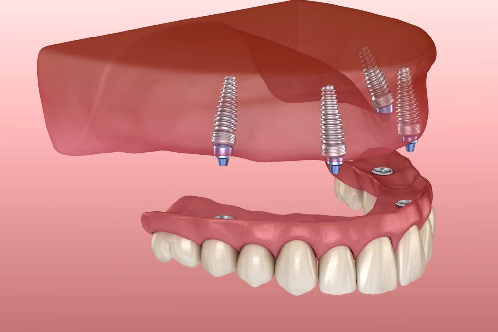 Implant-supported dentures