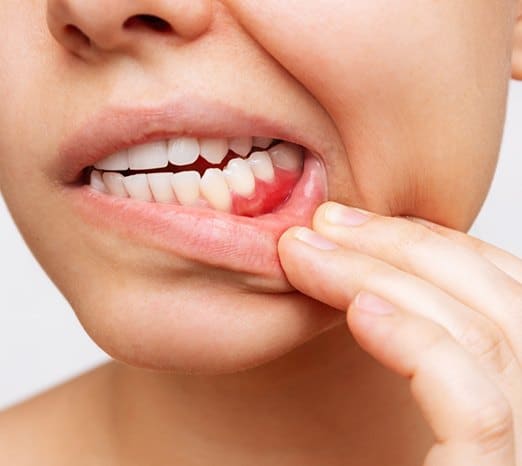 Gum Disease Treatment Options Gum Disease Treatment Options