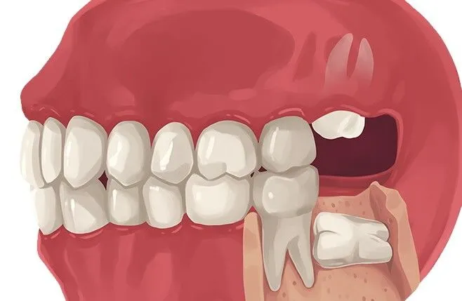 Wisdom Teeth Extraction Wisdom Teeth Extraction
