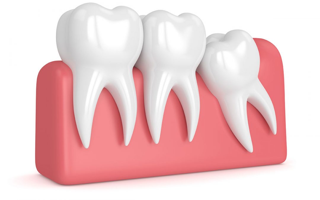 Wisdom Teeth Removal Wisdom Teeth Removal
