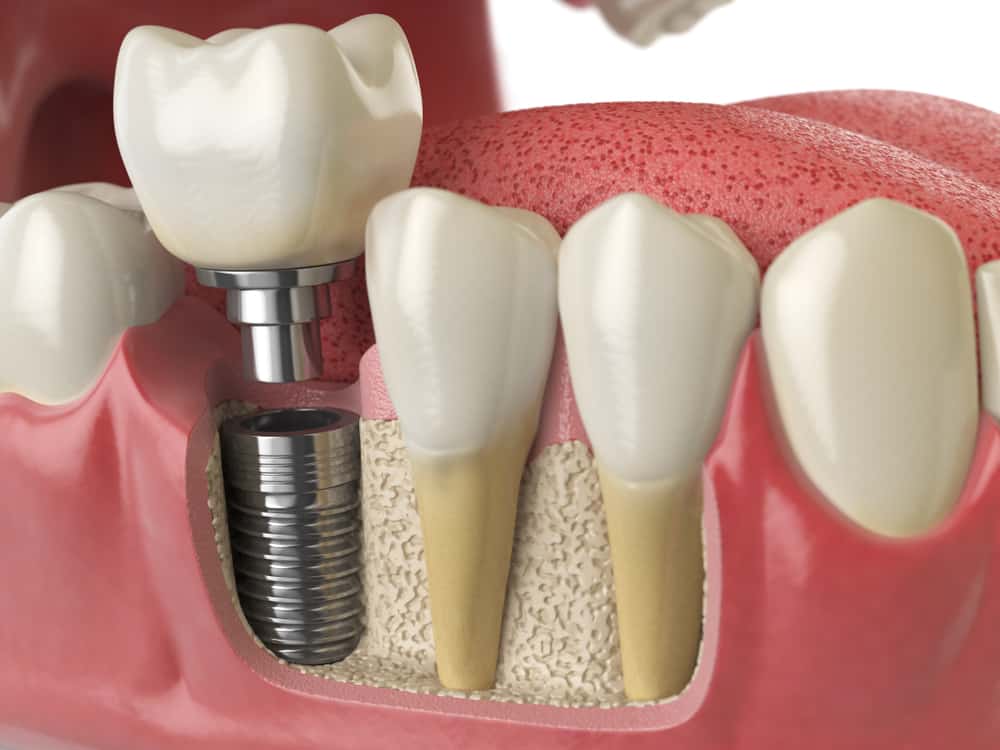 Dental Implants Dental Implants