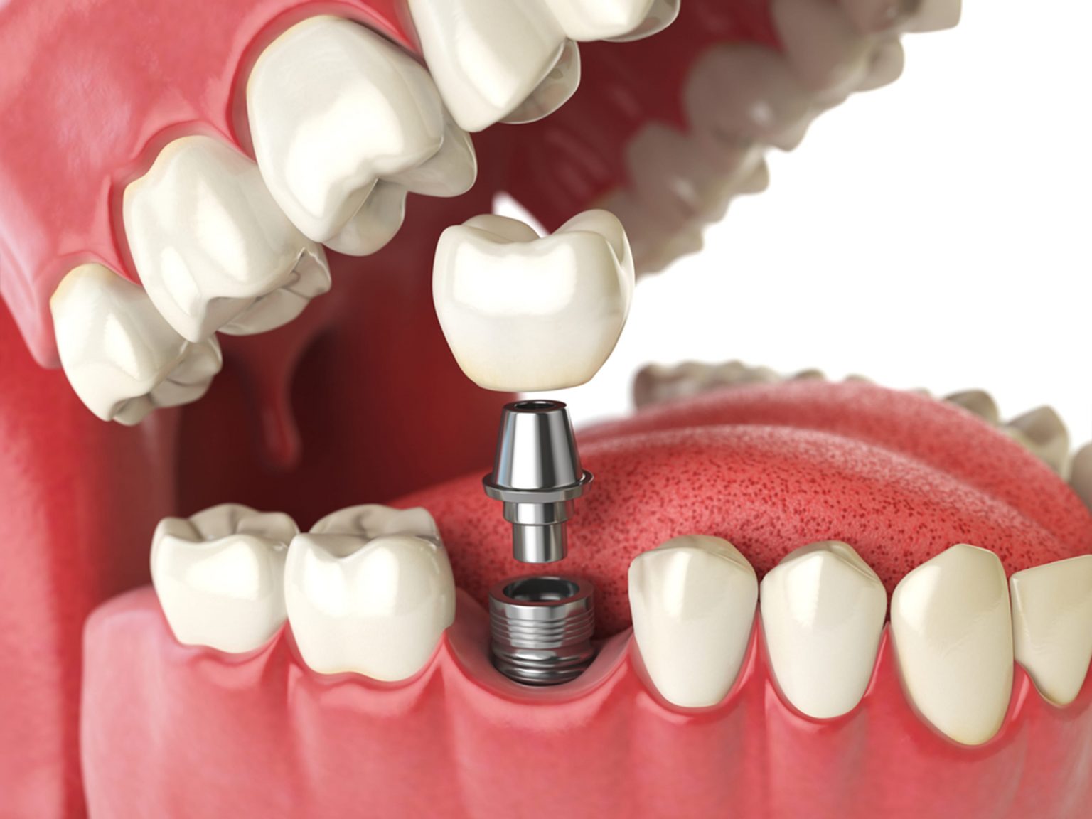 Types of Dental Implants Types of Dental Implants